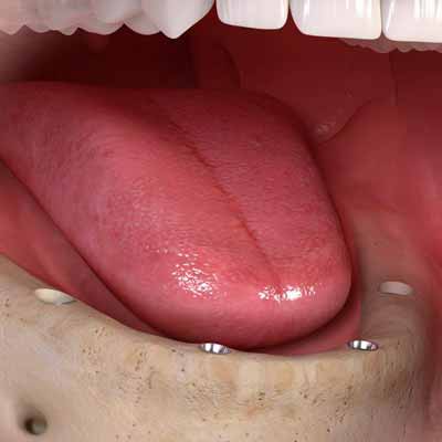 KU64 Zahnspezialisten Implantate setzen